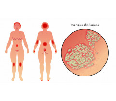 Homeopátia psoriasis cheveux corp