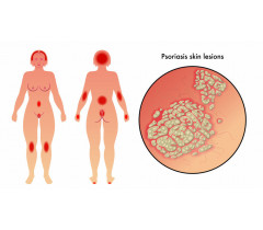 traitement psoriasis cuir chevelu homeopathie)