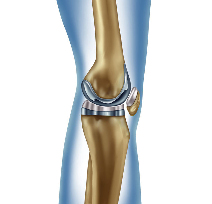 Arthrose 