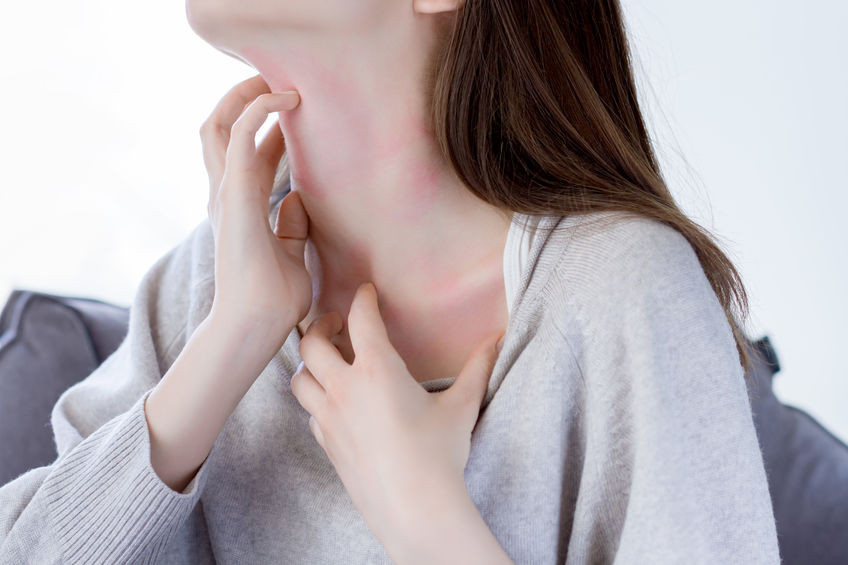 Eczéma