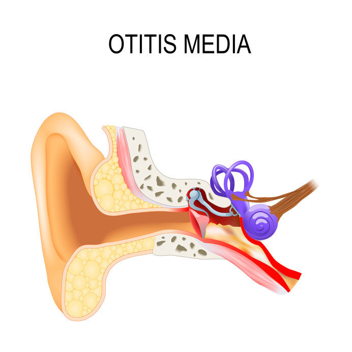 Otite