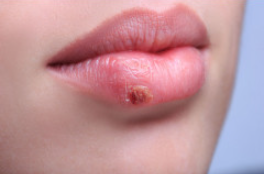 Herpès labial et huiles essentielles
